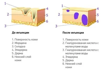 Гіалуронова кислота для особи властивості, користь і шкода, протипоказання (кислота) Гіалуронова кислота для особи властивості, користь і шкода, протипоказання
