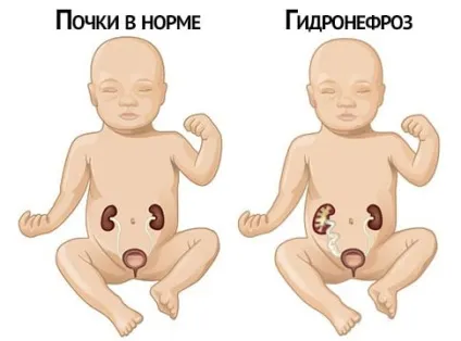 Гідронефроз нирок у плода при вагітності (вагітності) Гідронефроз нирок у плода при вагітності