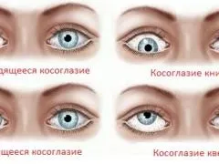 Альтернуюча косоокість у дітей і дорослих, особливо його лікування (альтернуюча) Альтернуюча косоокість у дітей і дорослих, особливо його лікування