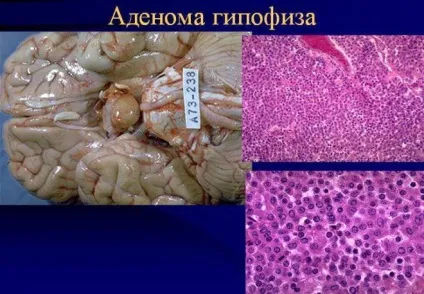 Аденома гіпофіза - симптоми пухлини у жінок і лікування, наслідки (гіпофіза) Аденома гіпофіза - симптоми пухлини у жінок і лікування, наслідки