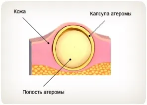 Атерома причини, лікування, операція (лікування) Атерома причини, лікування, операція
