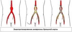 Аневризма аорти черевної порожнини - симптоми, діагностика, лікування (черевної) Аневризма аорти черевної порожнини - симптоми, діагностика, лікування