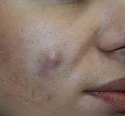 Антибіотик після видалення атероми, антибіотики після