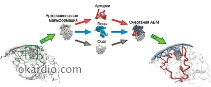 Артеріовенозна мальформация головного мозку, спинного та інших органів (артеріовенозна) Артеріовенозна мальформация головного мозку, спинного та інших органів