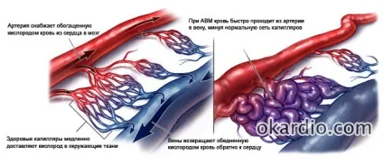 Артеріовенозна мальформация головного мозку, спинного та інших органів (спинного) Артеріовенозна мальформация головного мозку, спинного та інших органів