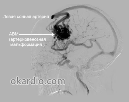 Артеріовенозна мальформация головного мозку, спинного та інших органів (артеріовенозна) Артеріовенозна мальформация головного мозку, спинного та інших органів