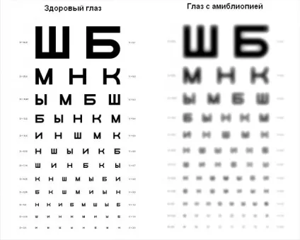 Аномалія рефракції ока їх корекція