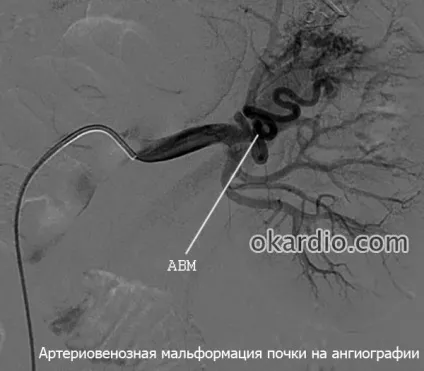 Артеріовенозна мальформация головного мозку, спинного та інших органів (інших) Артеріовенозна мальформация головного мозку, спинного та інших органів