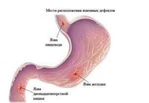 Чи беруть в армію з виразкою шлунка і дванадцятипалої кишки (виразкою) Чи беруть в армію з виразкою шлунка і дванадцятипалої кишки