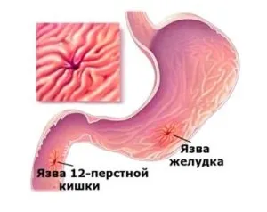 Чи беруть в армію з виразкою шлунка і дванадцятипалої кишки (беруть) Чи беруть в армію з виразкою шлунка і дванадцятипалої кишки