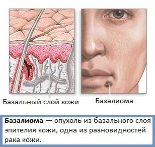 Базаліома - початкова стадія (фото) (початкова) Базаліома - початкова стадія (фото)