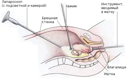 Вагітність після лапароскопії ендометріозу (жінок вагітніє протягом) Вагітність після лапароскопії ендометріозу