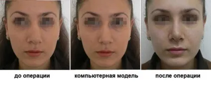 Великий ніс - пластика носа, операція, ускладнення після ринопластики, підготовка (пластика) Великий ніс - пластика носа, операція, ускладнення після ринопластики, підготовка
