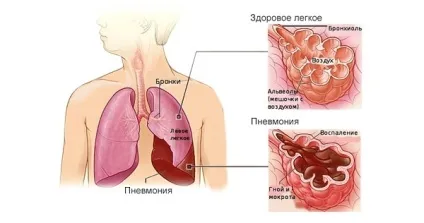 Болить ліва груди у жінок - що це значить причини болю і дискомфорту (причини) Болить ліва груди у жінок - що це значить причини болю і дискомфорту