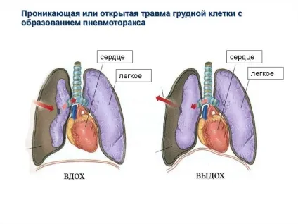 Болить ліва груди у жінок - що це значить причини болю і дискомфорту (причини) Болить ліва груди у жінок - що це значить причини болю і дискомфорту