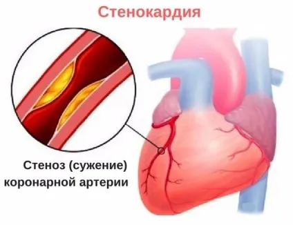 Болить ліва груди у жінок - що це значить причини болю і дискомфорту (болить) Болить ліва груди у жінок - що це значить причини болю і дискомфорту