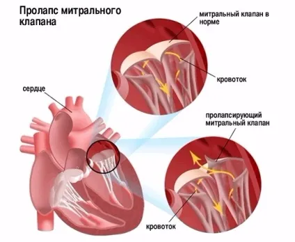 Болить ліва груди у жінок - що це значить причини болю і дискомфорту (жінок) Болить ліва груди у жінок - що це значить причини болю і дискомфорту