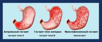 Чим небезпечний «звичайний» атрофічний гастрит