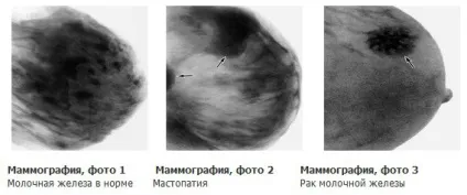 Що показує мамографія 1 (мамографія) Що показує мамографія 1