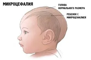 Цитомегаловірус у новонароджених лікування інфекції (інфекції) Цитомегаловірус у новонароджених лікування інфекції