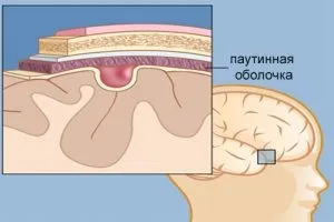 Цитомегаловірус у новонароджених лікування інфекції (формою цитомегаловірусної інфекції) Цитомегаловірус у новонароджених лікування інфекції