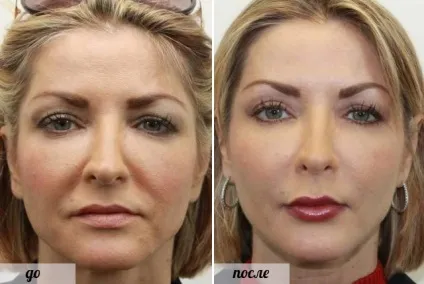 Що таке липофилинг особи огляд методу, фото - до - і - після (особи) Що таке липофилинг особи огляд методу, фото - до - і - після