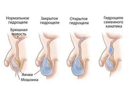 Що таке водянка яєчка