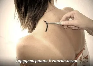 Гірудотерапія в гінекології