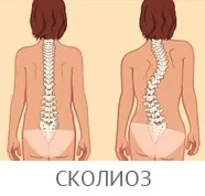 Діагностика остеохондрозу хребта шийного, поперекового, крижового відділів - диференціальна (шийного) Діагностика остеохондрозу хребта шийного, поперекового, крижового відділів - диференціальна