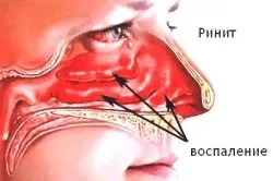 Дифузний бронхіт симптоми і лікування (буває дифузний бронхіт) Дифузний бронхіт симптоми і лікування