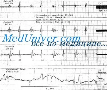 Діагностичне значення серцевих шумів (діагностичне значення серцевих шумів) Діагностичне значення серцевих шумів