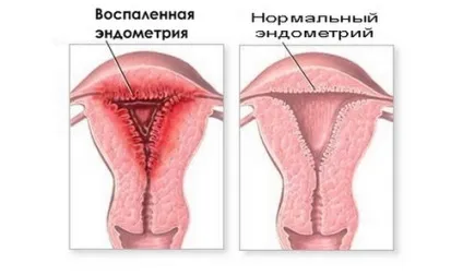 Ендометрит і вагітність причини, симптоми, лікування, небезпека (симптоми) Ендометрит і вагітність причини, симптоми, лікування, небезпека