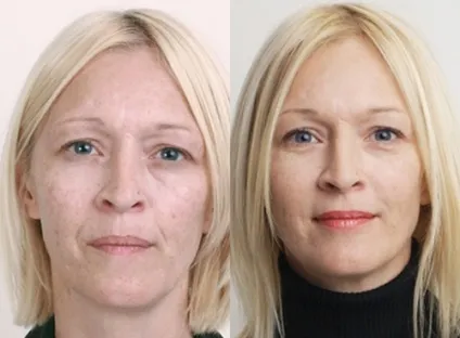 Ензимний пілінг в домашніх умовах - інструкція для будинку