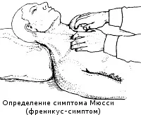 Френікус-симптом або симптом Мюссі-Георгієвського (симптом) Френікус-симптом або симптом Мюссі-Георгієвського