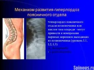 Гіперлордоз поперекового відділу хребта - симптоми, прояв (симптоми) Гіперлордоз поперекового відділу хребта - симптоми, прояв