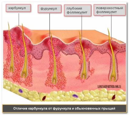 Фурункули і карбункули голови-симптоми, лікування причини (карбункули) Фурункули і карбункули голови-симптоми, лікування причини