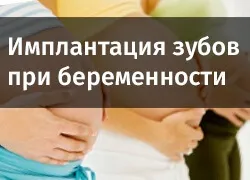 Імплантація зубів до, після і під час вагітності (імплантація) Імплантація зубів до, після і під час вагітності