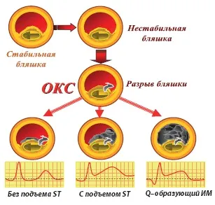 Інфаркт міокарда без підйому st - лікування серця (серця) Інфаркт міокарда без підйому st - лікування серця