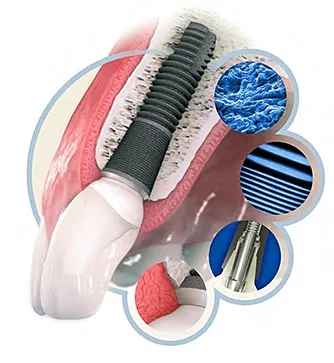 Імпланти зубів astra tech implant system (tech) Імпланти зубів astra tech implant system