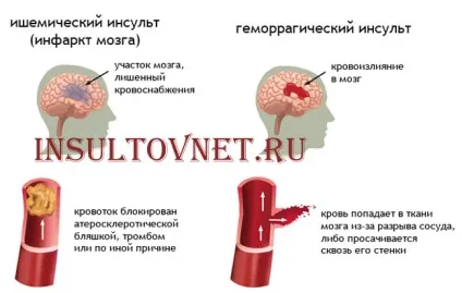 Інсульт у дітей ознаки і лікування (інсульт) Інсульт у дітей ознаки і лікування