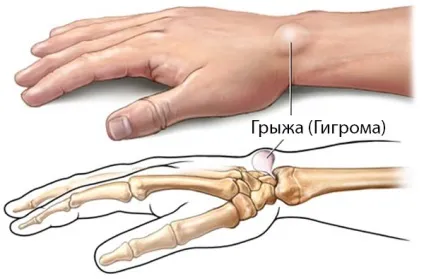 Грижа на руці причини, симптоми, види, методи лікування (грижа кисті руки) Грижа на руці причини, симптоми, види, методи лікування