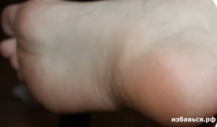 Як позбутися від огрубілих п'ят (п'ят) Як позбутися від огрубілих п'ят