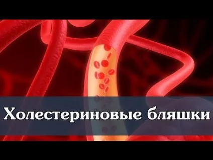 Як очистити судини від холестеринових бляшок і тромбів препарати, трави, мед (судини) Як очистити судини від холестеринових бляшок і тромбів препарати, трави, мед