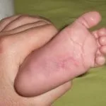 Як визначити грибок на ногах ознаки, симптоми, профілактика, все про ногах (ногах) Як визначити грибок на ногах ознаки, симптоми, профілактика, все про ногах