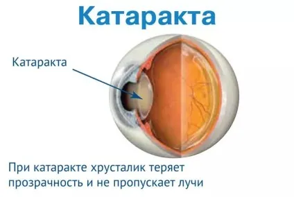 Як визначити катаракту очі (очі) Як визначити катаракту очі