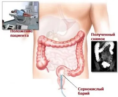 Як перевірити кишечник і пряму кишку опис способів, відео (способів) Як перевірити кишечник і пряму кишку опис способів, відео