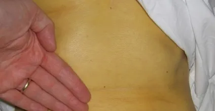 Як помирають від цирозу печінки симптоми перед смертю (вмирають) Як помирають від цирозу печінки симптоми перед смертю