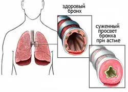 Інгалятори для лікування бронхіальної астми (препарату дихальних шляхах) Інгалятори для лікування бронхіальної астми