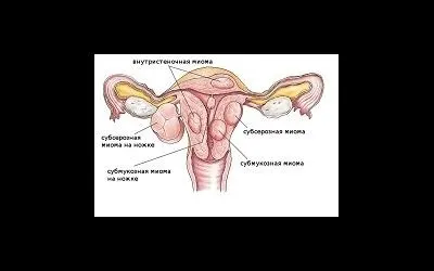 Як виглядає міома матки