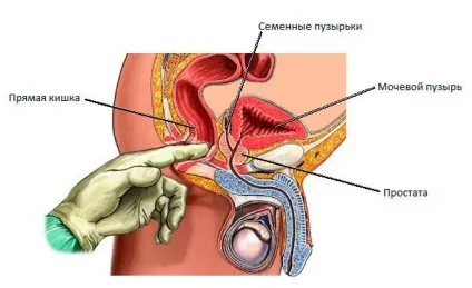 калькульозний простатит